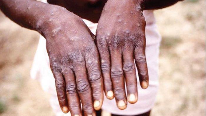 PAFI MAGETAN : Fakta-Fakta Penyakit Monkeypox: Menyebar di Asia dan Eropa hingga Gejalanya